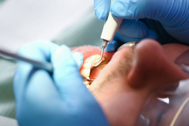 Best Emergency Tooth Extraction in Copperton, UT